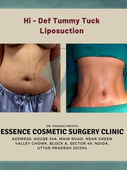 A before and after image showcasing a high-definition tummy tuck with liposuction. This front view clearly displays the dramatic change from a protruding belly to a flat and contoured stomach.