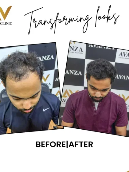 This client was experiencing thinning at the crown and a receding hairline. Our FUE hair restoration filled in these areas, resulting in a fuller, more youthful look.