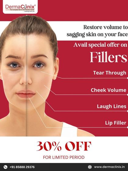 Dermal fillers are excellent for restoring lost volume in areas like the cheeks and under the eyes, as well as softening laugh lines. This graphic highlights the areas where fillers can provide a youthful lift.