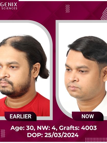 Witness the life-changing results for this 30-year-old after a 4003-graft procedure for Grade 4 baldness.