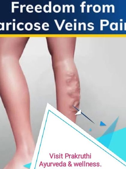 Ayurvedic treatments can provide lasting relief from conditions like varicose veins. Through specific therapies, I help manage the pain and discomfort associated with this condition.