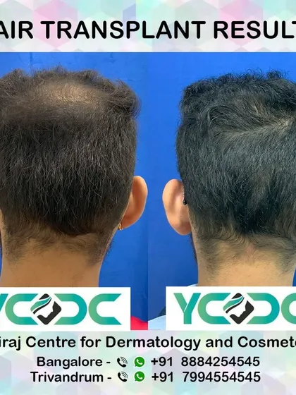 This rear view demonstrates the successful restoration of hair to the vertex (crown) area, one of the most common areas of male pattern baldness.