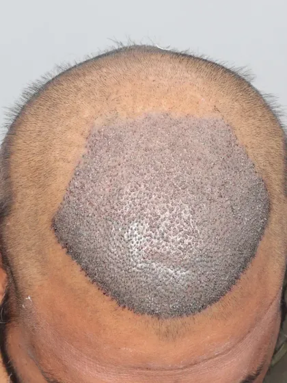 A Grade 4A hair loss case restored with 3500 grafts. These images show the precision of our graft placement.