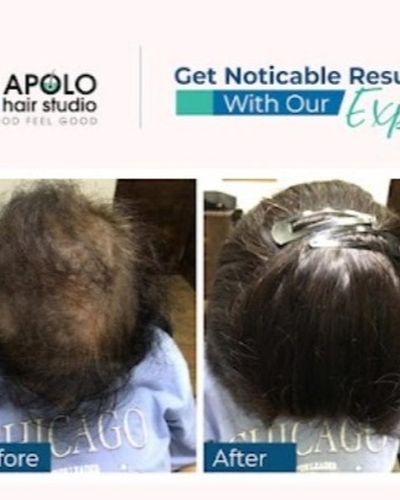 Hair Regrowth Treatments