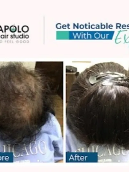 This before-and-after shows a female client with significant thinning on the crown. We used a clip-on hair topper to provide noticeable volume and coverage, a simple yet highly effective solution.