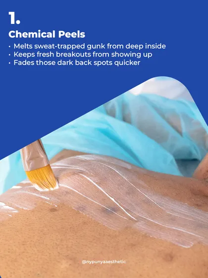 One of the most effective treatments for back acne is a chemical peel. It works by dissolving the sweat-trapped gunk deep within the pores, preventing new breakouts and helping to fade the dark spots left behind by old ones.