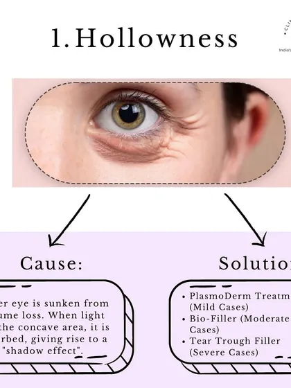Problem: Hollowness. This is caused by volume loss, creating a shadow effect. Our solutions include PlasmoDerm for mild cases, Bio-Filler for moderate cases, and Tear Trough Filler for severe cases.