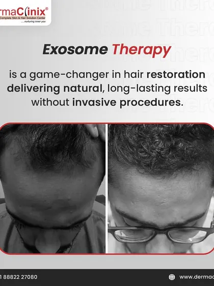Another powerful before-and-after result from Exosome therapy, demonstrating its effectiveness in restoring hair density.