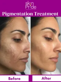 Advanced Skin Treatments