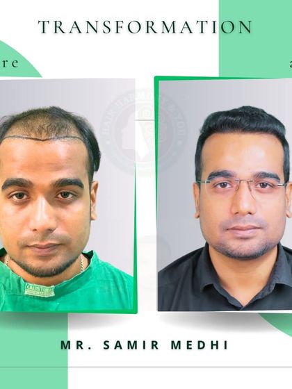 Mr. Samir Medhi's journey is a powerful example of what's possible. The 'before' shows the initial stage of hair loss, while the 'after' reveals a full, healthy head of hair and a renewed sense of self.