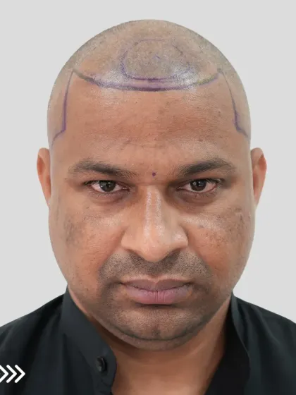 This is what a scalp looks like immediately after the procedure. Each dot is a carefully placed graft, the foundation of a future full head of hair.