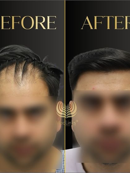 This before and after, with the patient's face blurred, highlights the effectiveness of our technique in restoring a natural hairline and density.