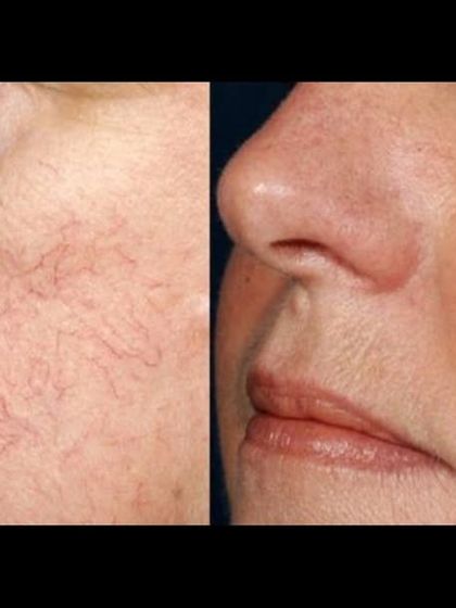 Facial telangiectasias, or spider veins on the face, can be effectively treated with laser therapy. This before-and-after shows a significant reduction in redness for a clearer complexion.