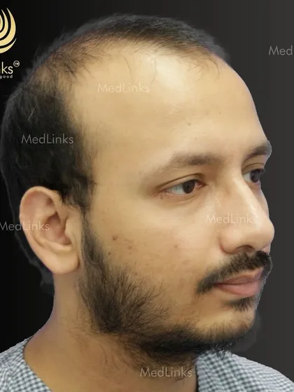 The patient's hair from the side before the procedure.