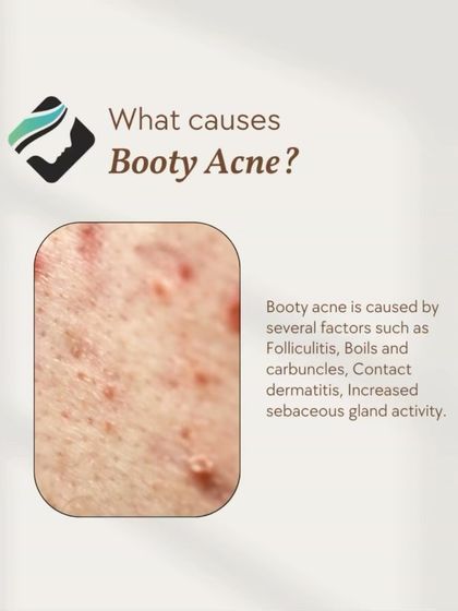 This infographic explains the causes of "booty acne," which is often folliculitis. I offer effective treatments like acne peels to address this common concern.