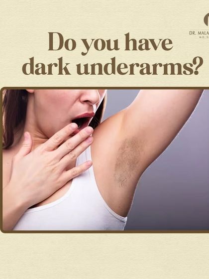 Dark underarms are a common aesthetic concern for many. This hyperpigmentation can be caused by a variety of factors, and understanding them is key to finding an effective solution for brighter, more even-toned skin.