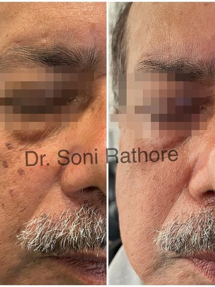 Here is another view of the results after a single laser session for pigmentation. You can see a noticeable fading of the dark spots and an overall improvement in skin brightness.