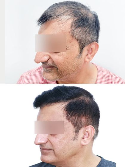 The side profile comparison emphasizes the natural flow and styling possibilities that come with a successful hair restoration.