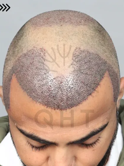 A fresh after-surgery look for a Norwood Grade 5 case. 5500 grafts were used to restore the hairline, frontal region, and crown.