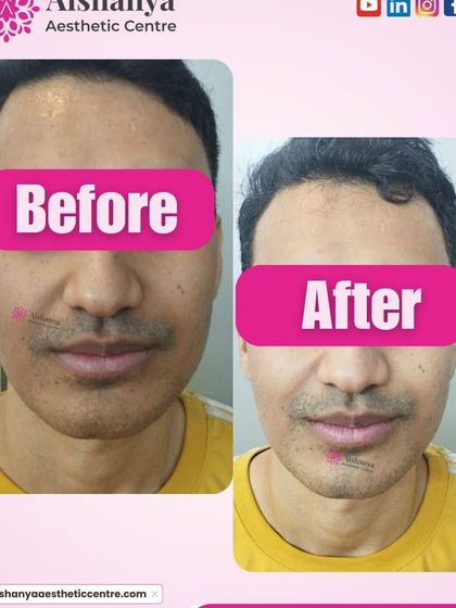 This result shows the effective removal of a small growth on the face. The procedure was quick, safe, and left the skin clear without any significant marking, demonstrating the precision of the techniques I use.