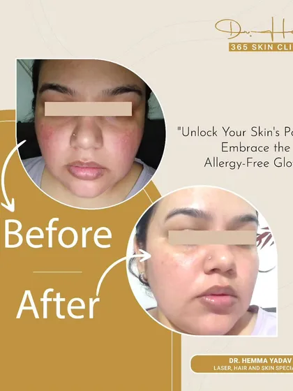 Skin allergies can be incredibly frustrating, causing redness, irritation, and discomfort. This client was struggling with persistent allergic reactions. Through a targeted treatment plan, we were able to calm the inflammation and restore her skin's natural barrier, revealing a clear and healthy complexion.