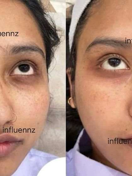 This transformation focuses on reducing dark circles and freckles. The 'after' image shows a brighter under-eye area and a visible reduction in pigmentation, leading to a more even and refreshed skin tone.