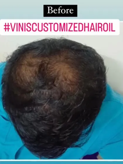 Another 'before' image showing the starting point for a customer concerned with scalp visibility and hair thinning.