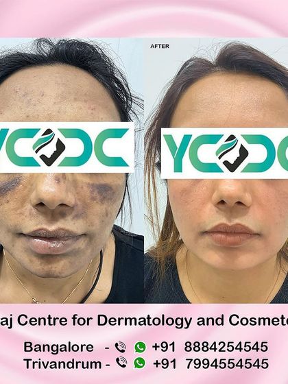 A frontal view of the patient who experienced facial burns. The after photo shows a dramatic improvement in skin tone and texture, underscoring the effectiveness of a medically supervised treatment plan.