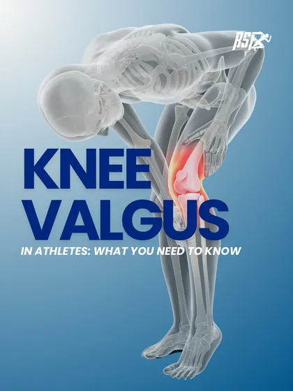 Knee Valgus in Athletes: What You Need to Know. This infographic introduces the topic of inward knee collapse, a common movement fault that can significantly increase injury risk if left unaddressed.