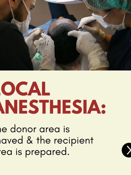 Local Anesthesia: For your comfort, the procedure is performed under local anesthesia. We prepare both the donor and recipient areas for the transplant.