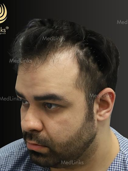 The patient's hair from the side before the procedure.