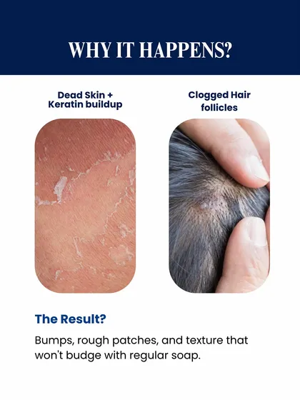 Keratosis Pilaris happens when dead skin and keratin build-up clog hair follicles. This results in the rough patches and bumps that regular soap cannot resolve, requiring specialized dermatological care.