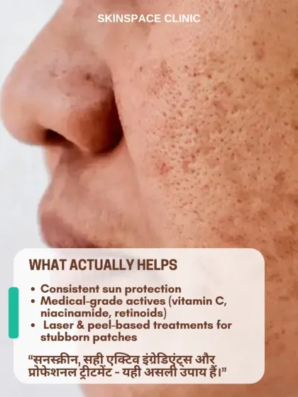 This graphic outlines what actually helps in treating pigmentation. A combination of consistent sun protection, medical-grade actives like Vitamin C and retinoids, and professional laser or peel treatments is the most effective strategy.