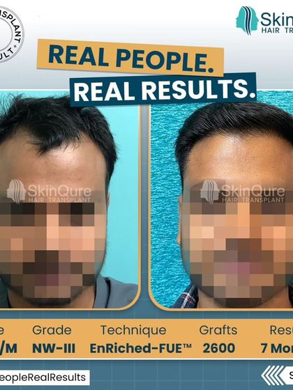 A frontal view of the 24-year-old patient's transformation. The before and after comparison clearly shows the restored hairline and increased density, which has significantly improved his facial framing.