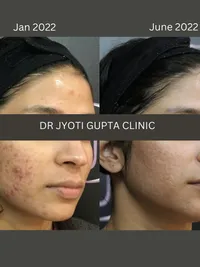 Acne & Scar Revision