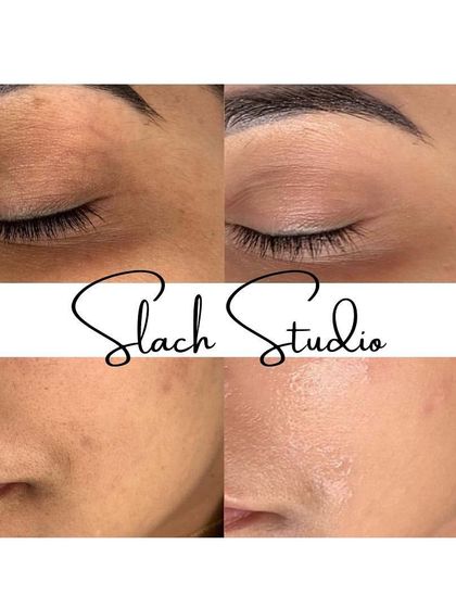 Notice the improvement in both skin texture and tone. The "after" photo shows smoother skin on the eyelid and a reduction in spots on the cheek.