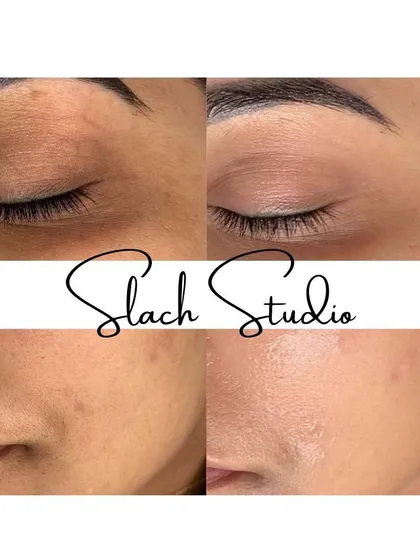 Notice the improvement in both skin texture and tone. The "after" photo shows smoother skin on the eyelid and a reduction in spots on the cheek.