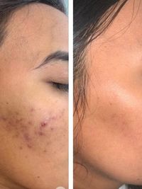 Acne & Acne Scar Treatment