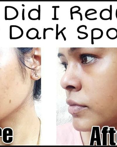 Natural Skin Brightening Treatments