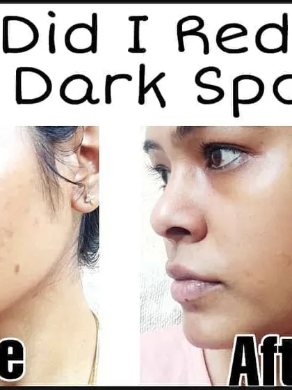 Many of you asked how I reduced my dark spots, so I wanted to share my journey. This image shows the difference after consistently using my DIY dark spot removal treatments. The spots have faded significantly, and my skin looks clearer and healthier.