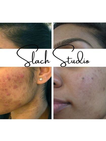 A fantastic result for a client struggling with acne. The treatment cleared active acne and reduced post-inflammatory hyperpigmentation.