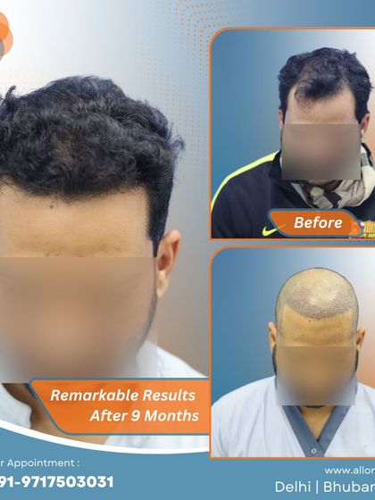 Remarkable results after just 9 months. This series shows the before, post-op, and after stages, highlighting the efficiency and effectiveness of the procedure.
