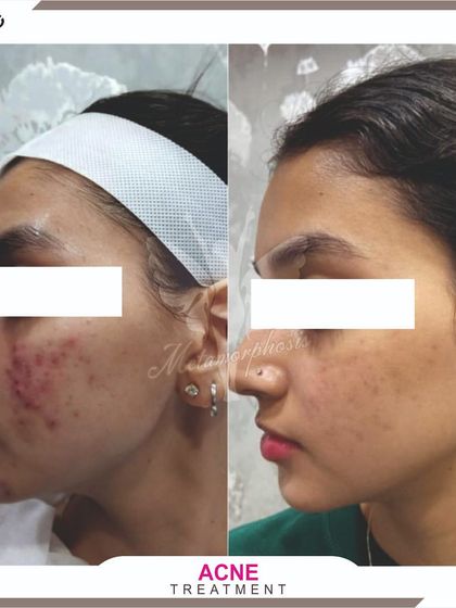 This transformation shows how we address both active acne and the redness it leaves behind. Our goal is to not only treat the pimples but also restore an even, healthy skin tone.