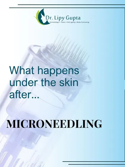 This series explains what happens under your skin after a microneedling treatment. The process triggers a natural healing and regeneration response that builds new collagen and elastin.