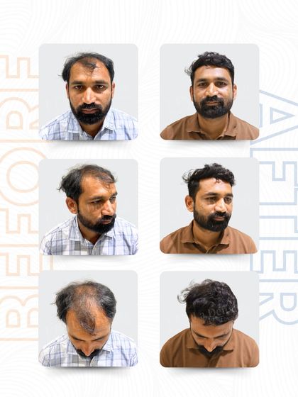 This six-panel image shows Pandurang Patil's complete transformation. The 3,517 grafts restored his hairline and crown, proving what self-belief and the right procedure can do.