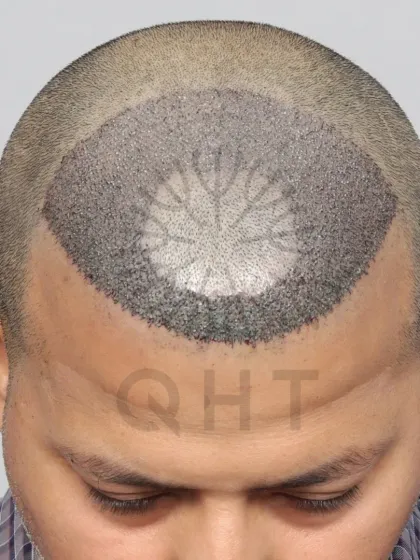 A high-density hair transplant where we preserved the patient's natural frontal tuft while restoring the surrounding areas with 3500 grafts.