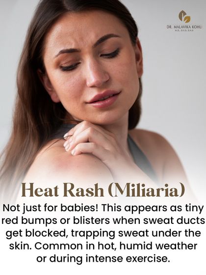 Heat rash, or miliaria, is not just for babies. It appears as tiny red bumps or blisters when sweat ducts become blocked, trapping sweat under the skin. It is common in hot, humid weather or during intense exercise.