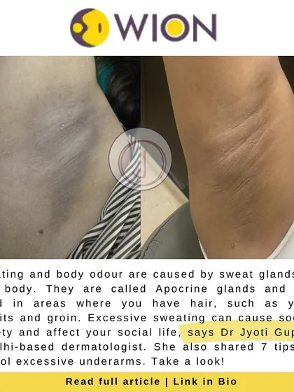 Excessive underarm sweating and body odour can be managed effectively. This before and after shows the improvement in skin texture and pigmentation following a personalized treatment plan at my clinic.