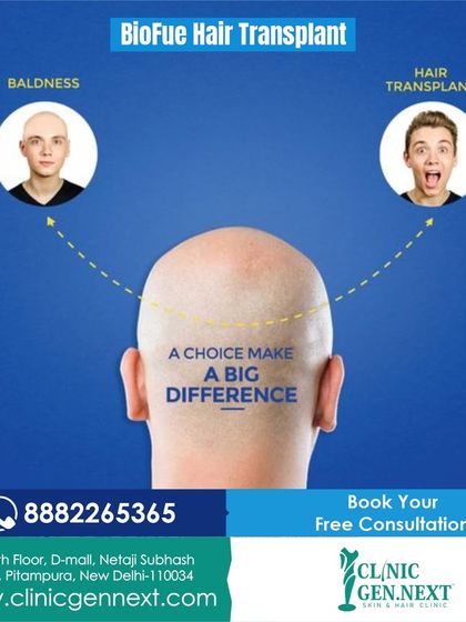 Bio-FUE Hair Transplant: a choice that makes a big difference. This advanced technique can offer superior results for your hair restoration.