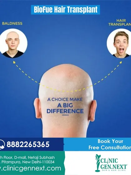 Bio-FUE Hair Transplant: a choice that makes a big difference. This advanced technique can offer superior results for your hair restoration.